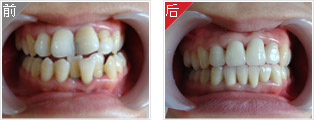 隐形牙套矫正牙齿对比